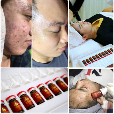 Combo 5 lọ Tế bào gốc Acne Ampoule Larian (làm giảm mụn sưng viêm, làm đầy sẹo rỗ, xoá mờ vết thâm)