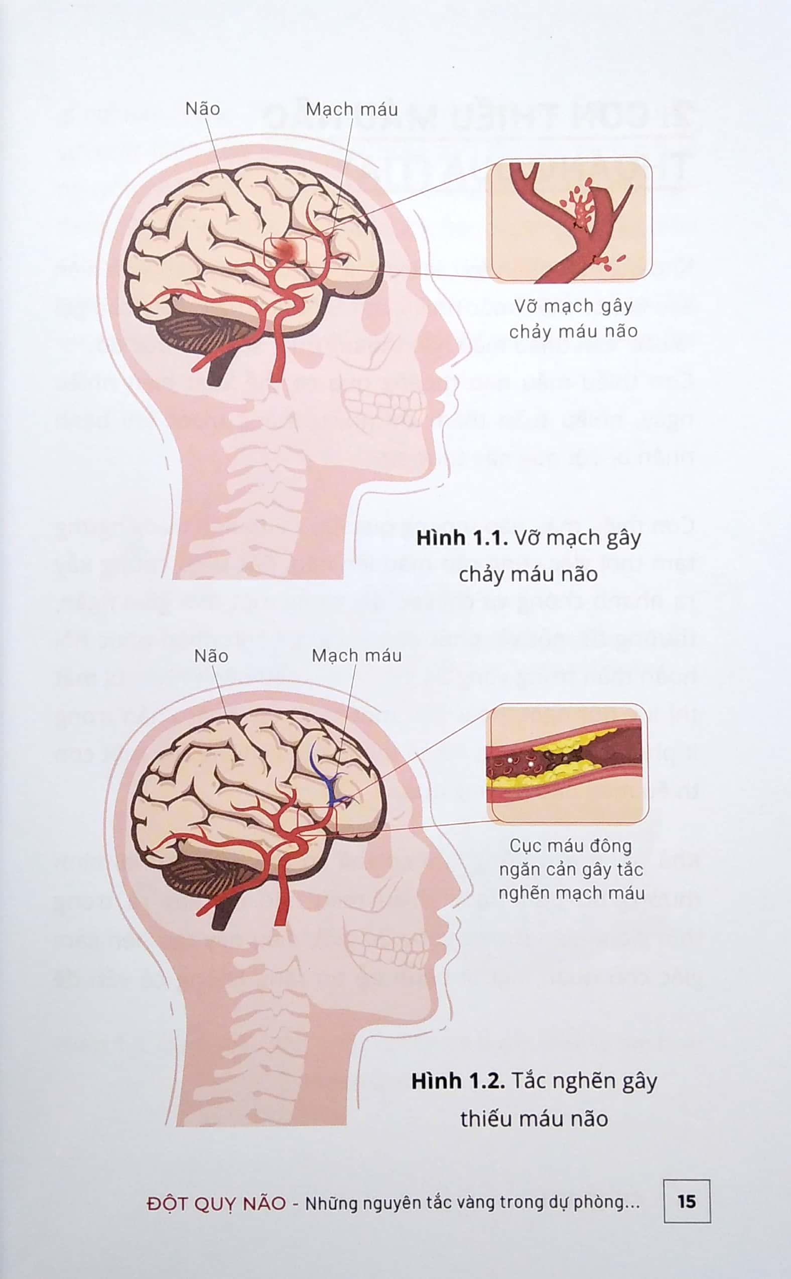 Đột Quỵ Não – Những Nguyên Tắc Vàng Trong Dự Phòng Và Chăm Sóc Đột Quỵ