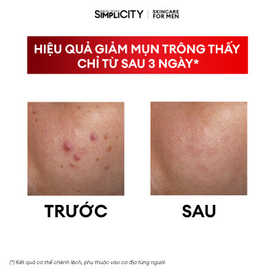 Bộ đôi giảm mụn sưng viêm Men Stay Simplicity cho nam Zinc PCA 1% + Terpineol-4 100g + 30ml