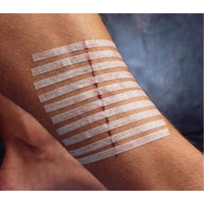 Miếng dán thay chỉ khâu da Steri-Strip R1546 6mm x 100mm (1/4IN x 4IN)