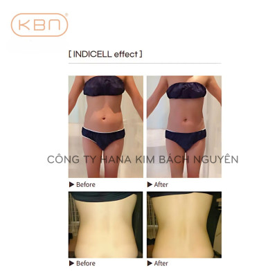 Máy Thon Gọn Cơ Thể INDICELL Hàn Quốc