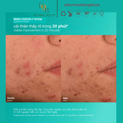 Dưỡng ẩm dành riêng cho da mụn ACNE BIOTIC MOISTURIZER giúp ngăn ngừa mụn tái phát của Dermalogica