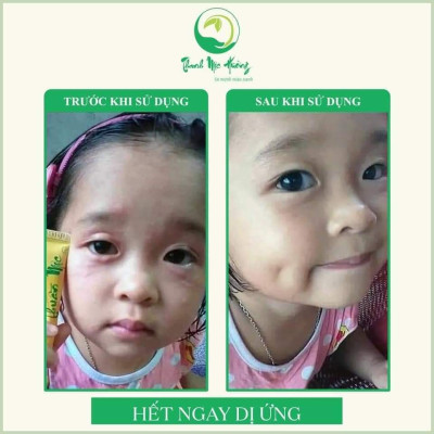 Combo 5 tuýp kem bôi da thuần mộc trị hăm chàm sữa mụn nhọt Thanh Mộc Hương 16g